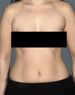 Liposuction Patient #6 Before Photo # 1