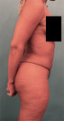 Liposuction Patient #5 After Photo Thumbnail # 12