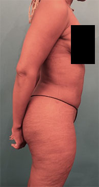 Liposuction Patient #5 After Photo # 12