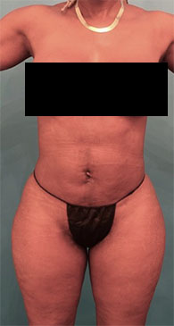 Liposuction Patient #5 After Photo # 2