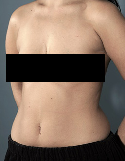 Liposuction Patient #6 Before Photo # 3