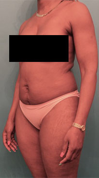 Liposuction Patient #5 Before Photo # 5