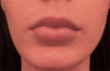 Lip Filler Patient #6 Before Photo Thumbnail # 1