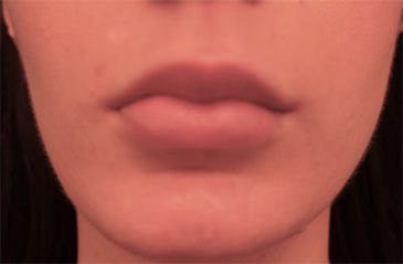 Lip Filler Patient #6 Before Photo # 1