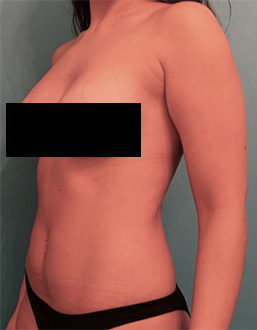 Liposuction Patient #6 After Photo # 4