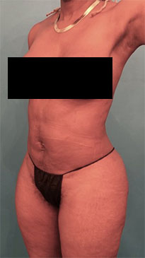 Liposuction Patient #5 After Photo # 6