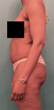 Liposuction Patient #5 Before Photo # 7