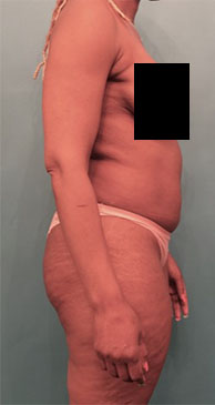 Liposuction Patient #5 Before Photo # 11