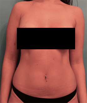 Liposuction Patient #6 After Photo # 2