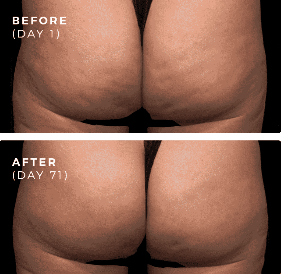 Can Cellulite Go Away? - Body Sculpting Clinics